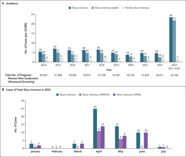 Bizarre blip: Cases of fetuses with flipped organs quadrupled in China 6 Panel A shows the incidence of fetal situs inversus that had been diagnosed at two obstetrical centers from January 2014 through July 2023. The numbers above the bars are the total case numbers by year. Incidence is reported as the number of cases per 10,000 pregnant women who underwent ultrasound screening. Panel B shows the number of fetal situs inversus cases that had been diagnosed at the International Peace Maternity and Child Health Hospital of China Welfare Institute (IPMCH), Shanghai, and the Hunan Provincial Maternal and Child Health Care Hospital (HPM), Changsha, from January 2023 through July 2023.